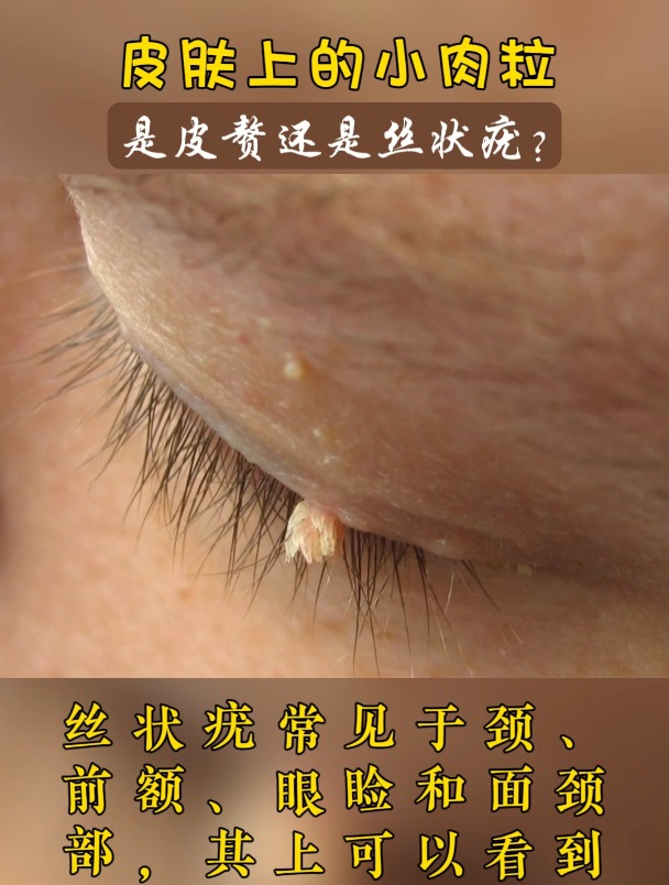 颈部出现小肉粒,是皮赘还是丝状疣?