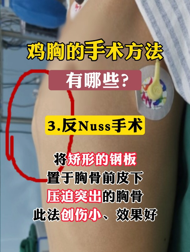 鸡胸的手术方法有哪些?