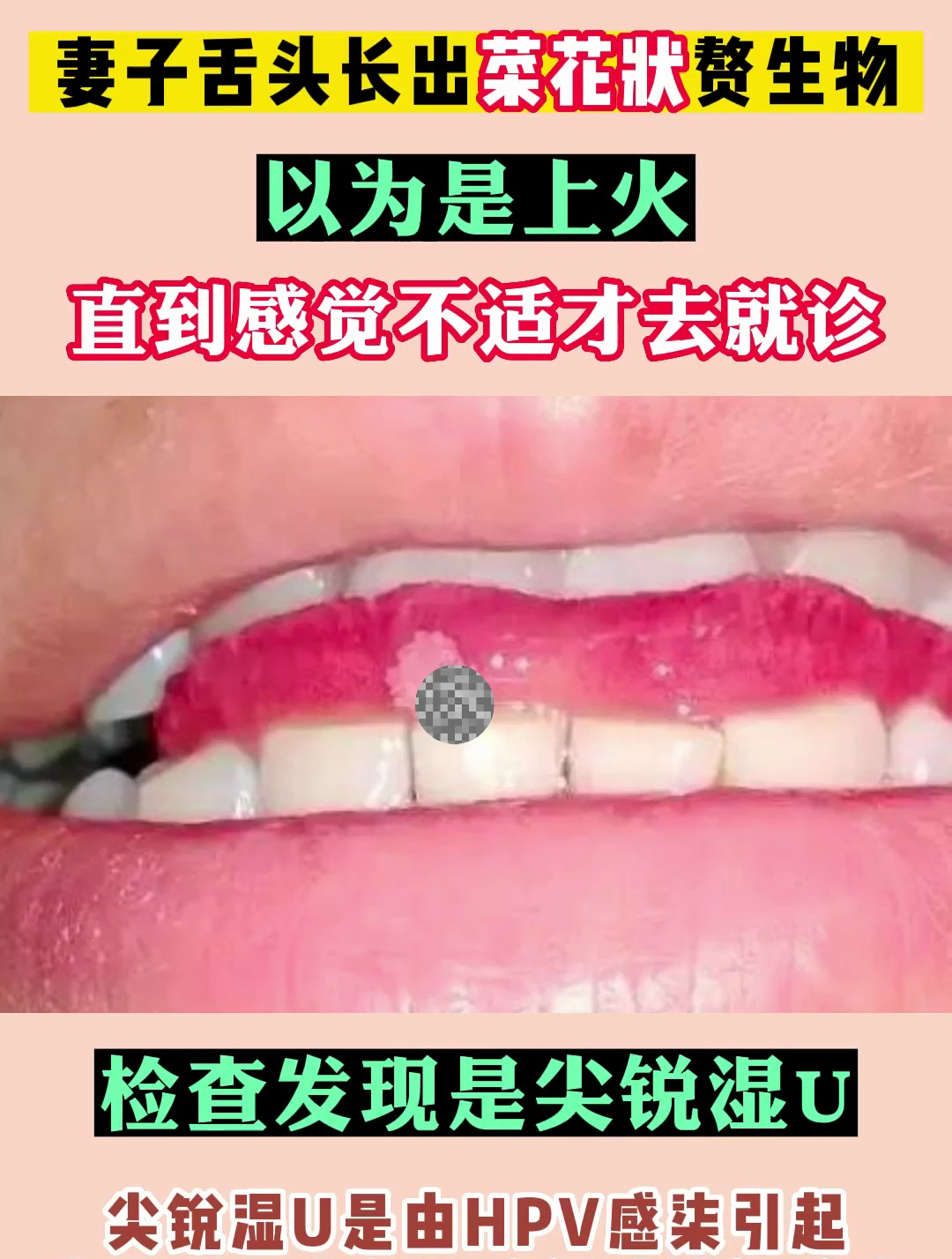妻子舌头长菜花,刚开始以为上火了……