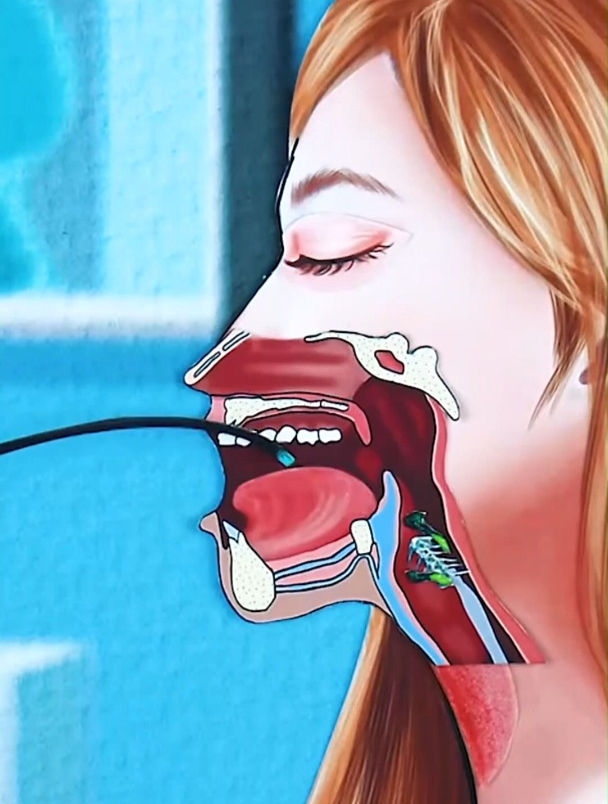 解压视频之鱼骨卡在喉咙和扁桃体结石