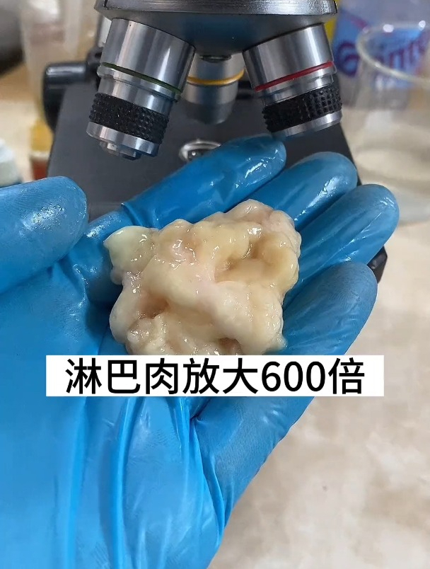 少吃肥肉尽量避免淋巴肉
