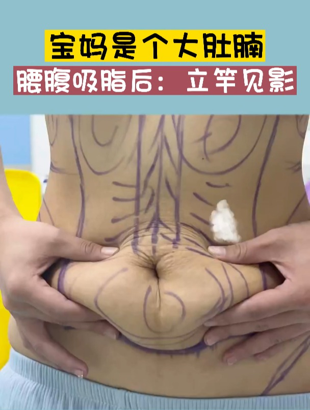 如何减肚腩及腰部赘肉?宝妈是个大肚腩,腰腹吸脂后:立竿见影