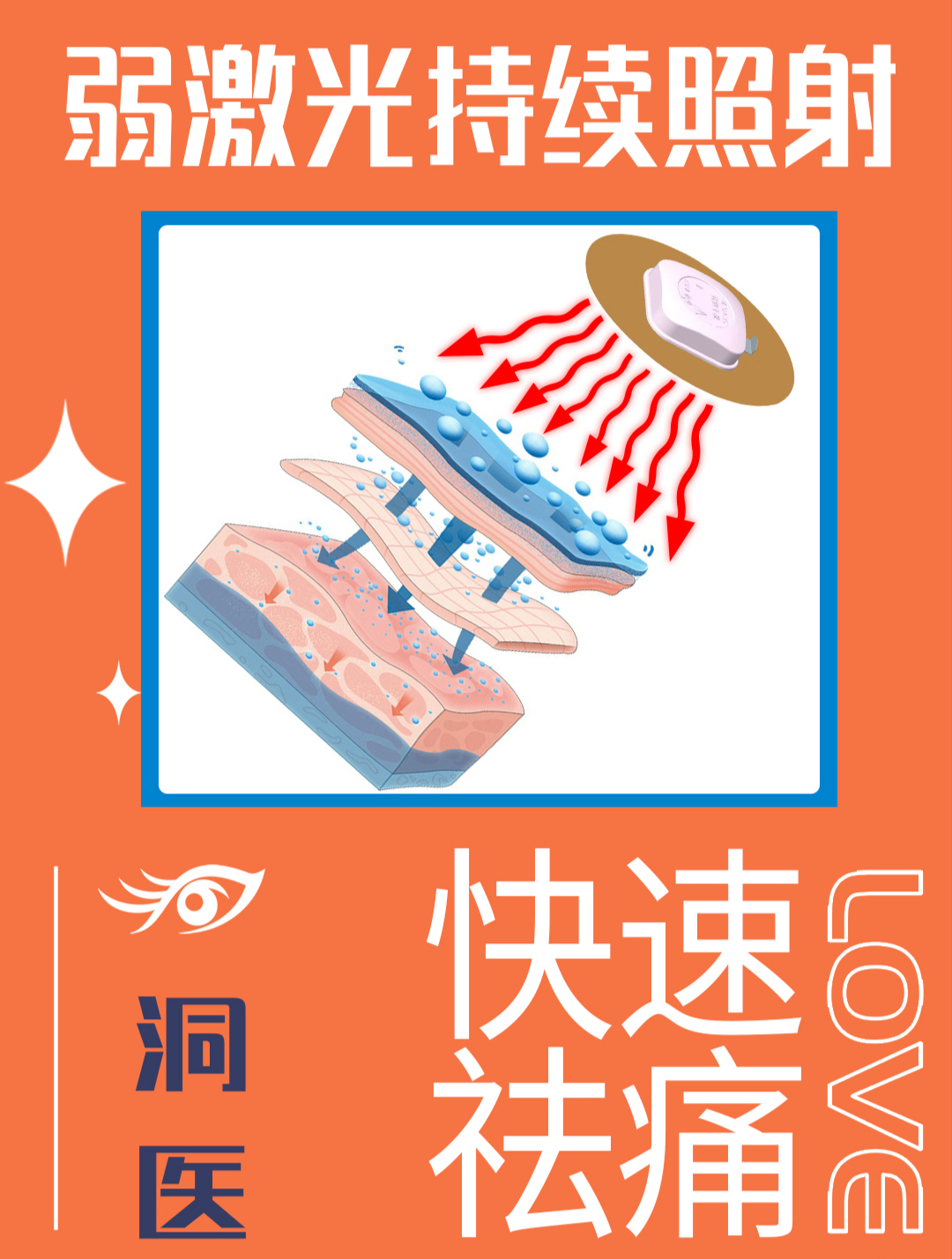 小腿肌肉拉伤的症状