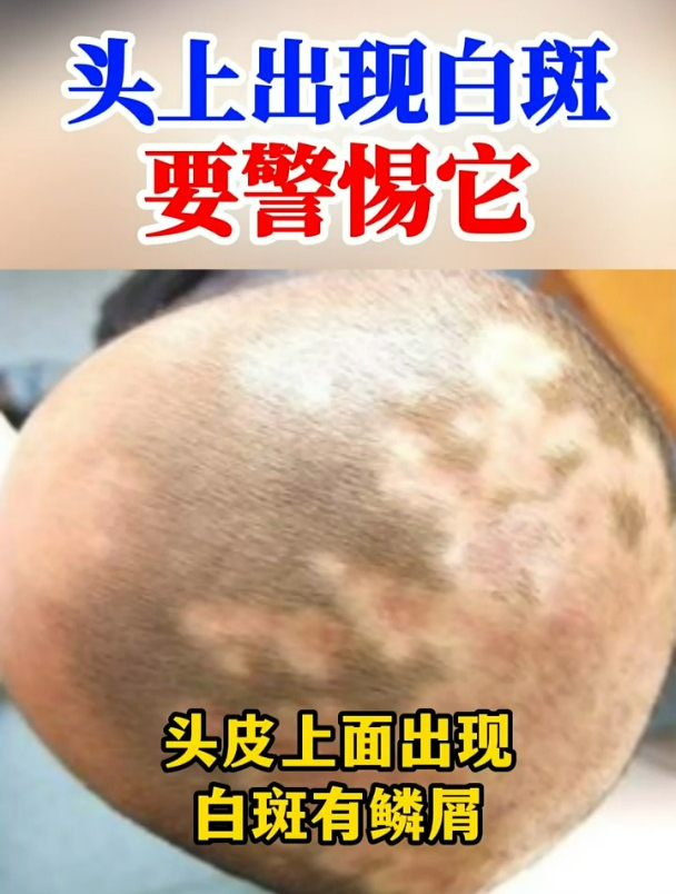 小孩子头皮上有白斑,表面有鳞屑,这是什么呢?