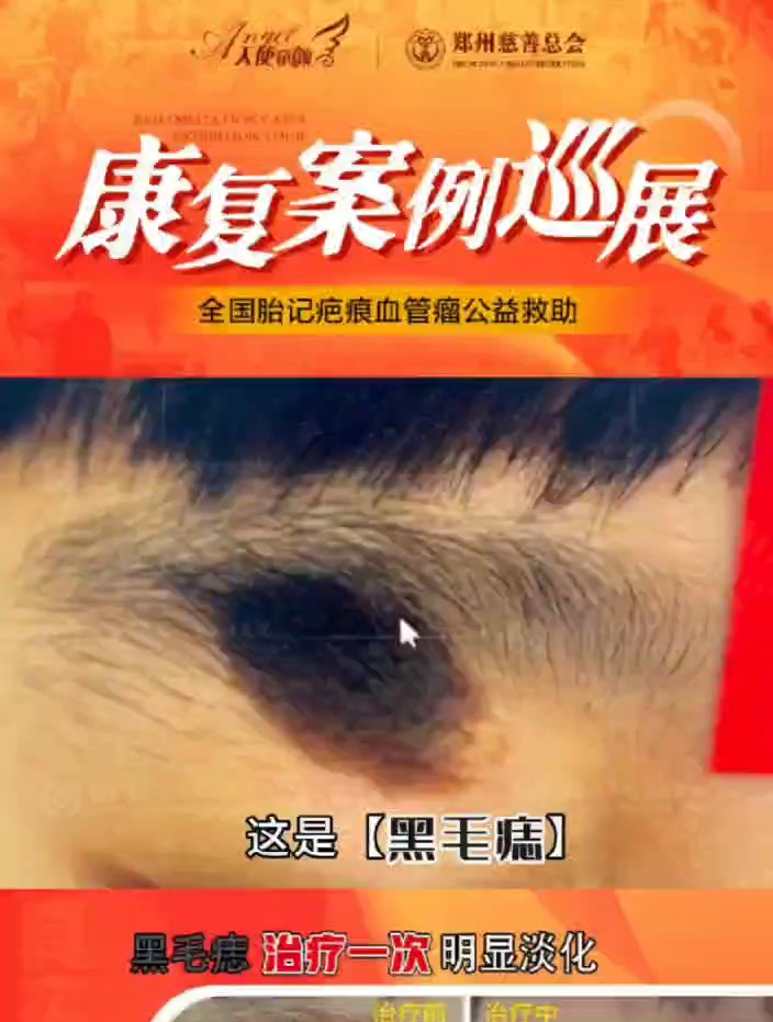 眼皮上长黑毛痣 在我院治疗效果非常不错 河南科大胎记医学研究院