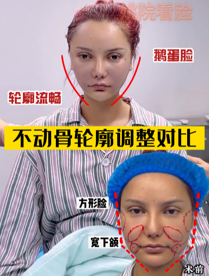 宽下颌 如何不动骨调整流畅外轮廓 秒变鹅蛋脸