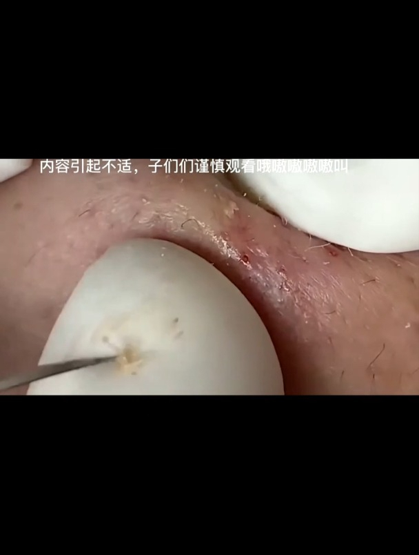 37包子痘痘黑头粉刺拜拜挤痘痘解压强迫症看了很享受