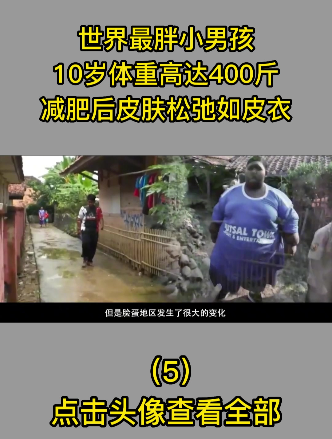 世界最胖小男孩,10岁体重高达400斤,减肥后皮肤松弛如皮衣5