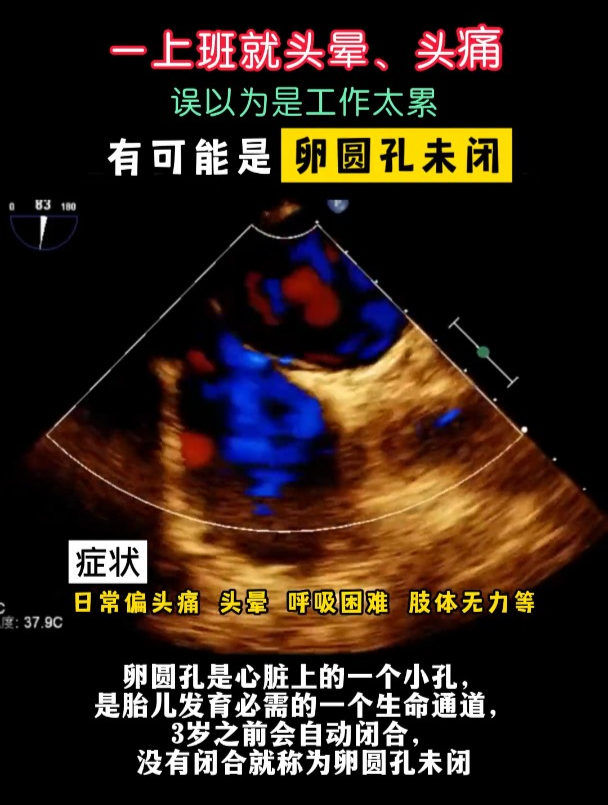一上班就头痛 有可能是卵圆孔未闭