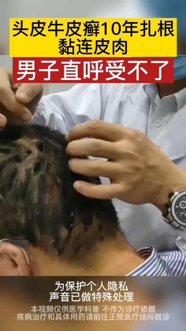 头皮牛皮癣10年扎根,黏连皮肉,男子直呼受不了!