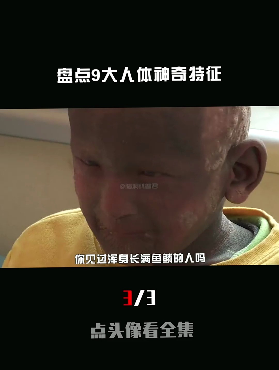 盘点九大人体神奇特征:浑身长满鱼鳞、心脏在右边,还有人有尾巴