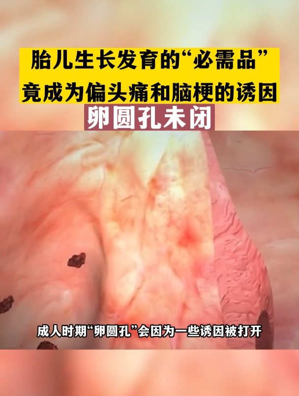卵圆孔是胎儿时期发育重要通道,3岁之后没有闭合称为卵圆孔未闭