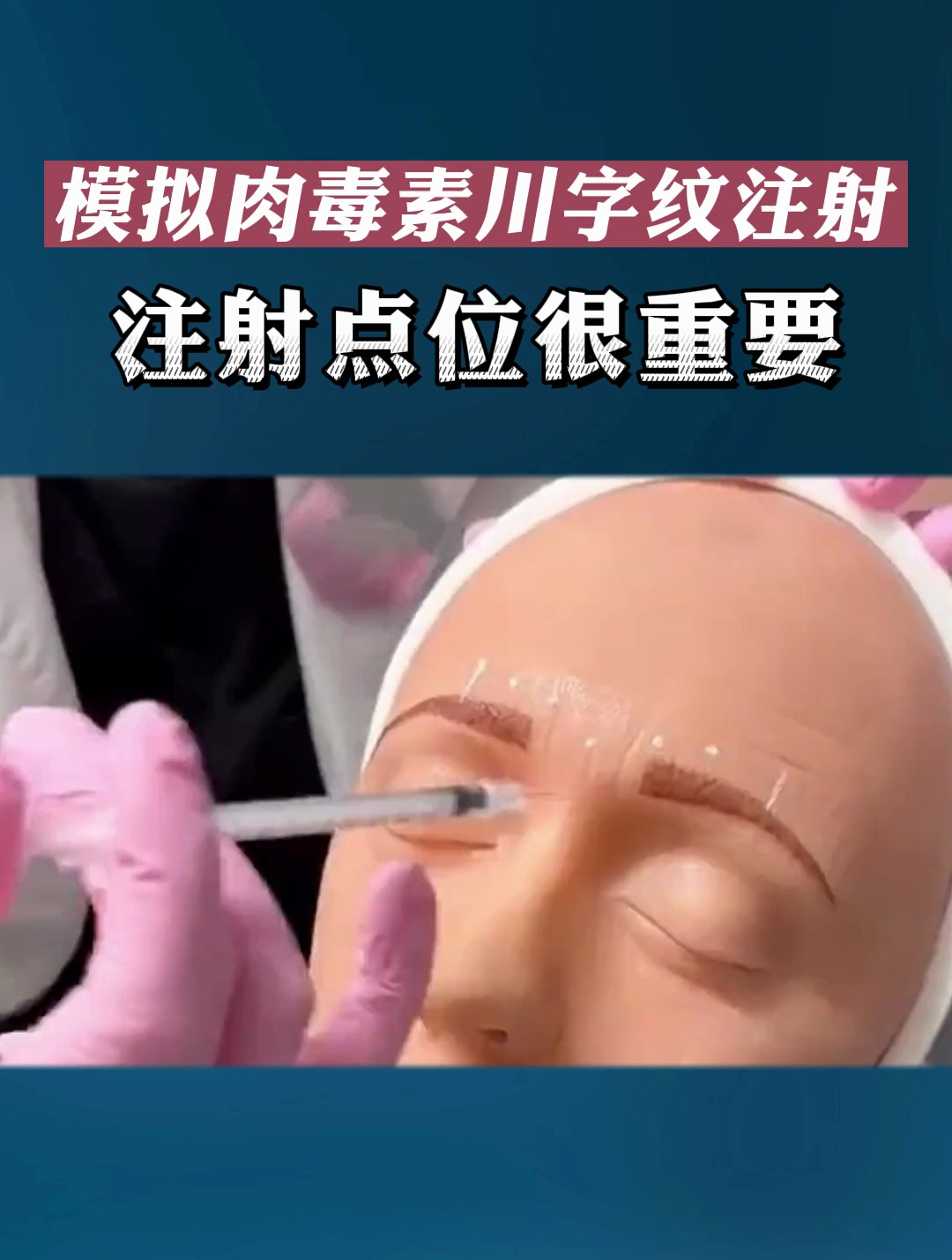 模拟肉毒素川字纹注射注射点位很重要