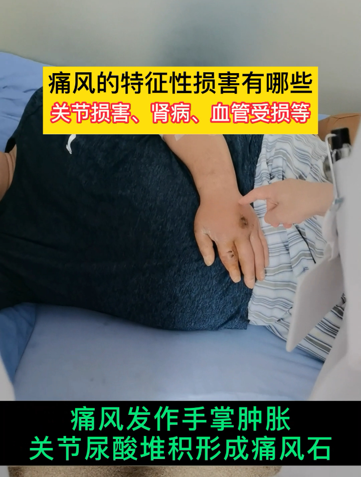 痛风的特征性损害有哪些?你知道吗?