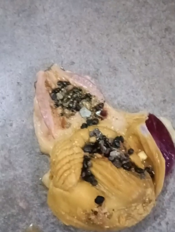 如果你有结石,这个鸡身上的宝物,你一定要知道!