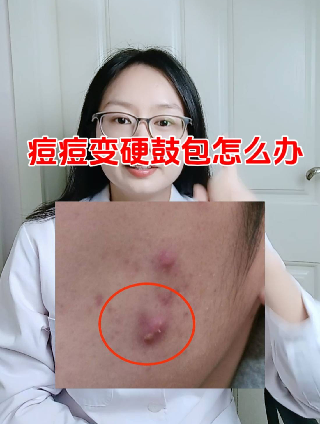 痘痘变成硬硬的鼓包,硬块痘痘怎么快速消除