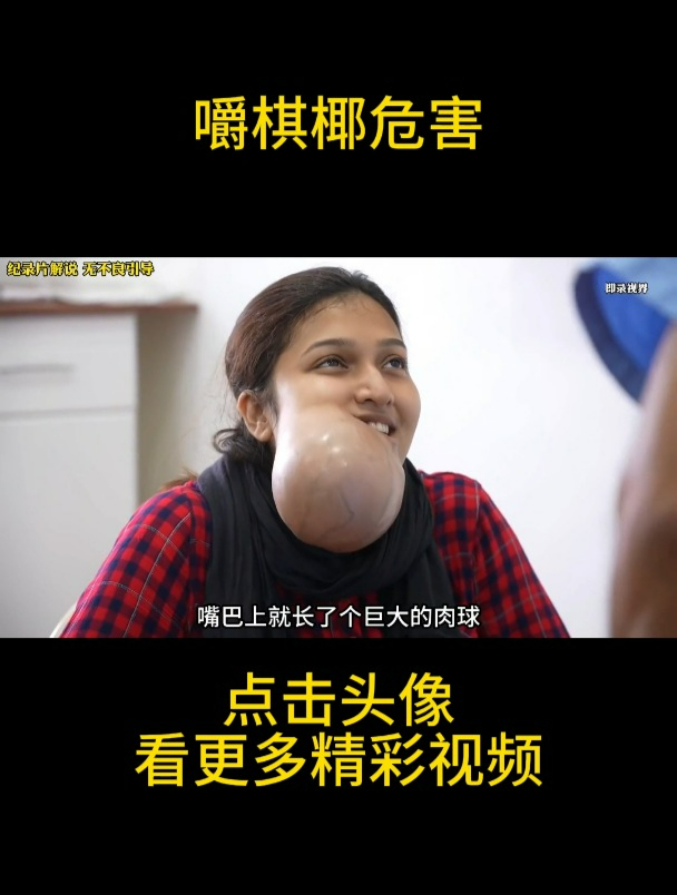 印度女孩因为嚼槟榔,嘴巴长了巨大的肉球,看完视频你还敢嚼吗?