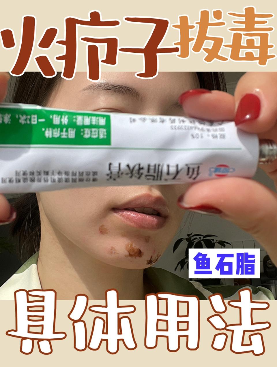 鱼石脂软膏的用法tips祛痘常备药