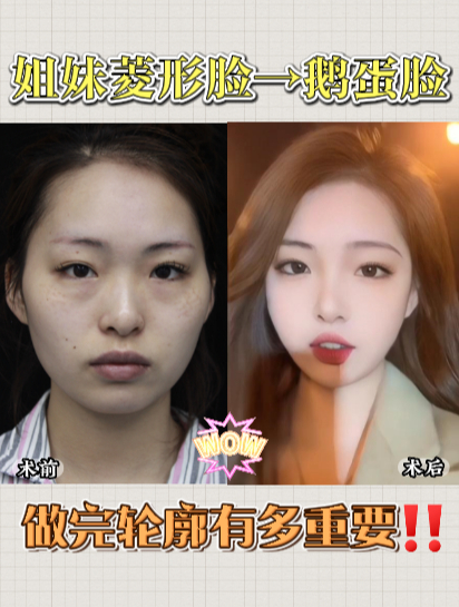 颧骨部突出只能磨骨吗?微创降颧骨 菱形脸变鹅蛋脸