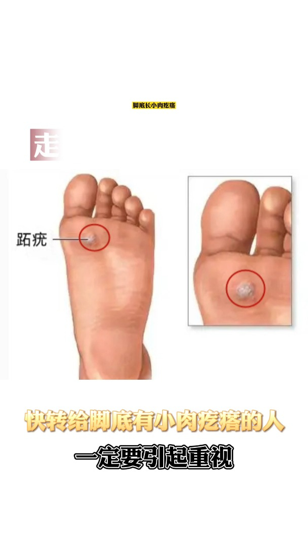 脚上长硬疙瘩,走路都痛,这叫跖疣,怎么办,看这里