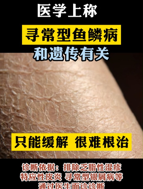秋冬季节,你的腿上也有这样的“蛇皮”吗?