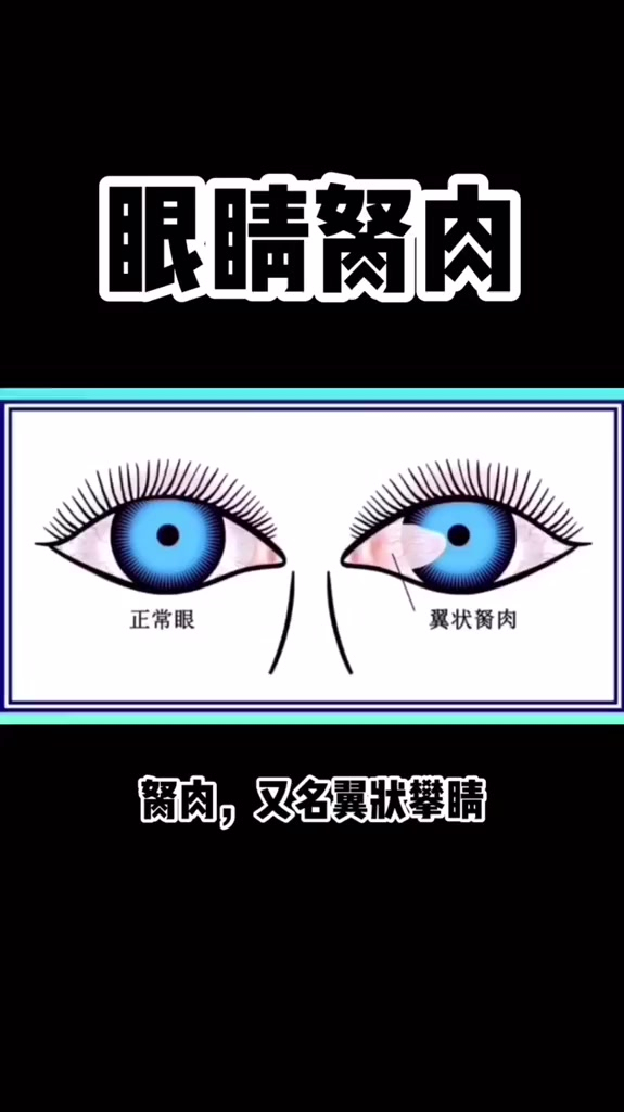 你真正了解胬肉吗?