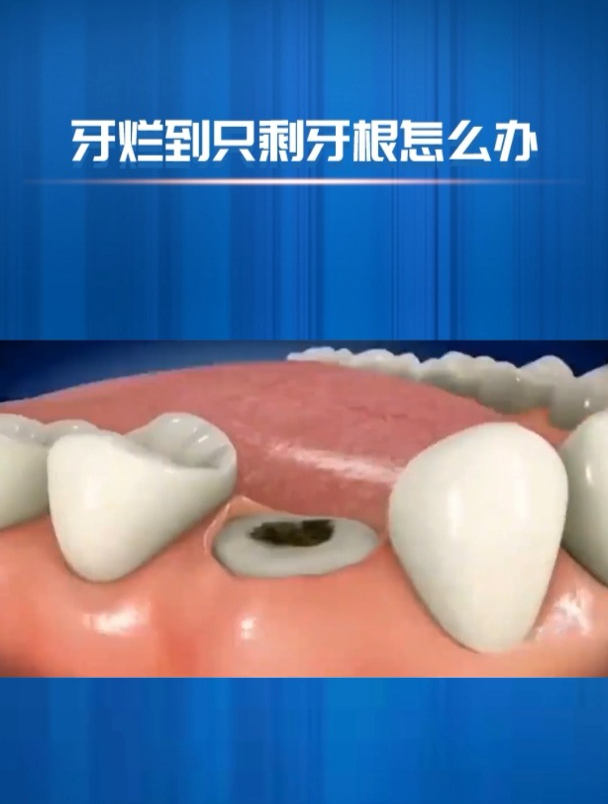 牙齿烂到只剩牙根怎么办?