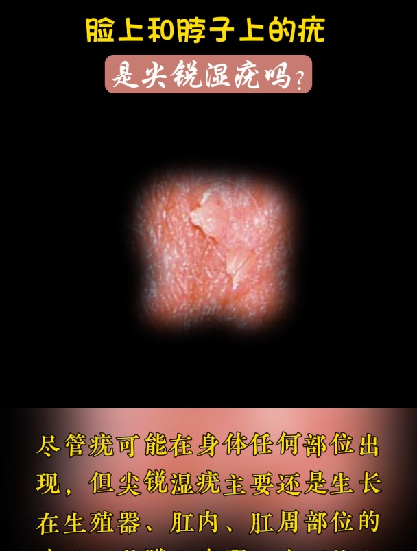 尖锐湿疣是怎么引起的?了解一下HPV病毒!