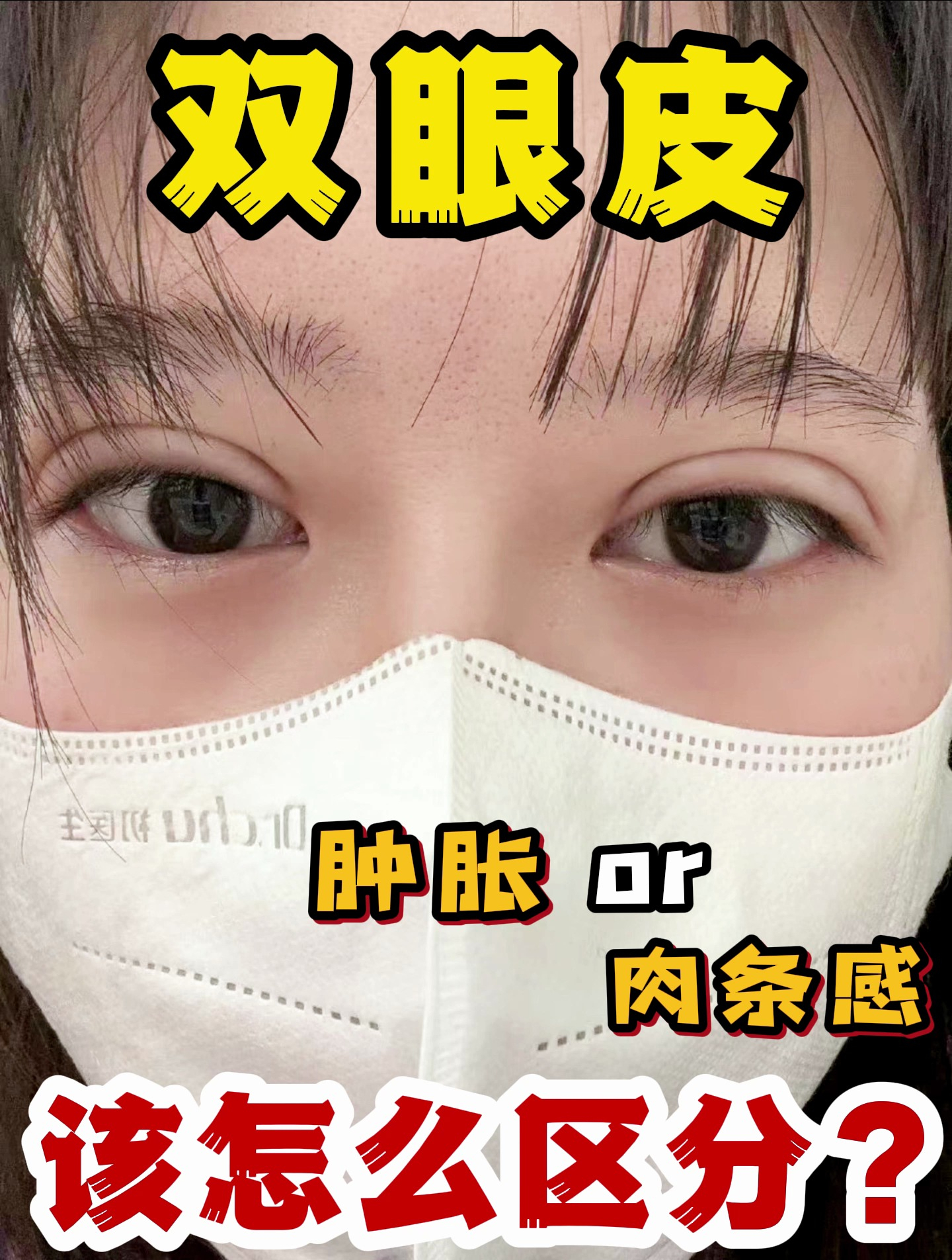 双眼皮水肿还是肉条感,该怎么区分?