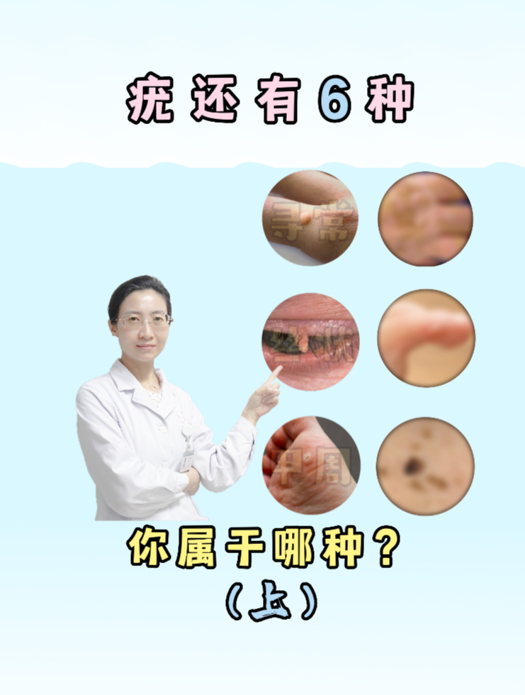 除了尖锐湿疣,疣还有这几种类型,看看自己属于哪一种?(上)
