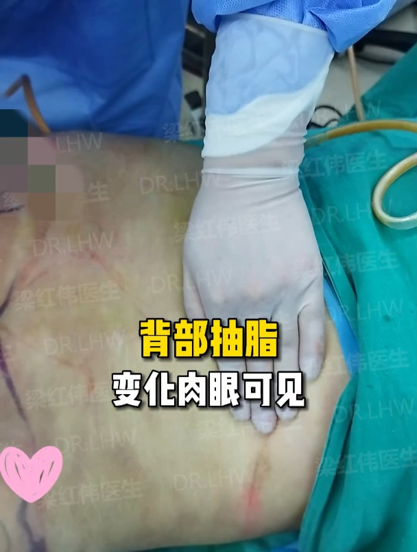 抽脂瘦后背,两侧的对比变化,肉眼可见