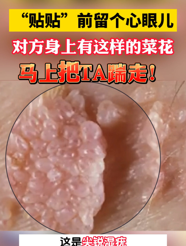 “贴贴”前留个心眼儿,对方身上有这样的菜花,马上把他踹走