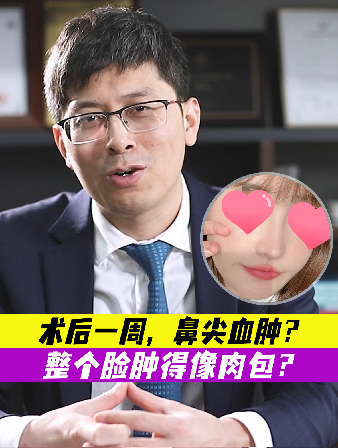 隆鼻术后一周,鼻尖出现血肿?整个脸肿得像肉包?过多久能恢复?