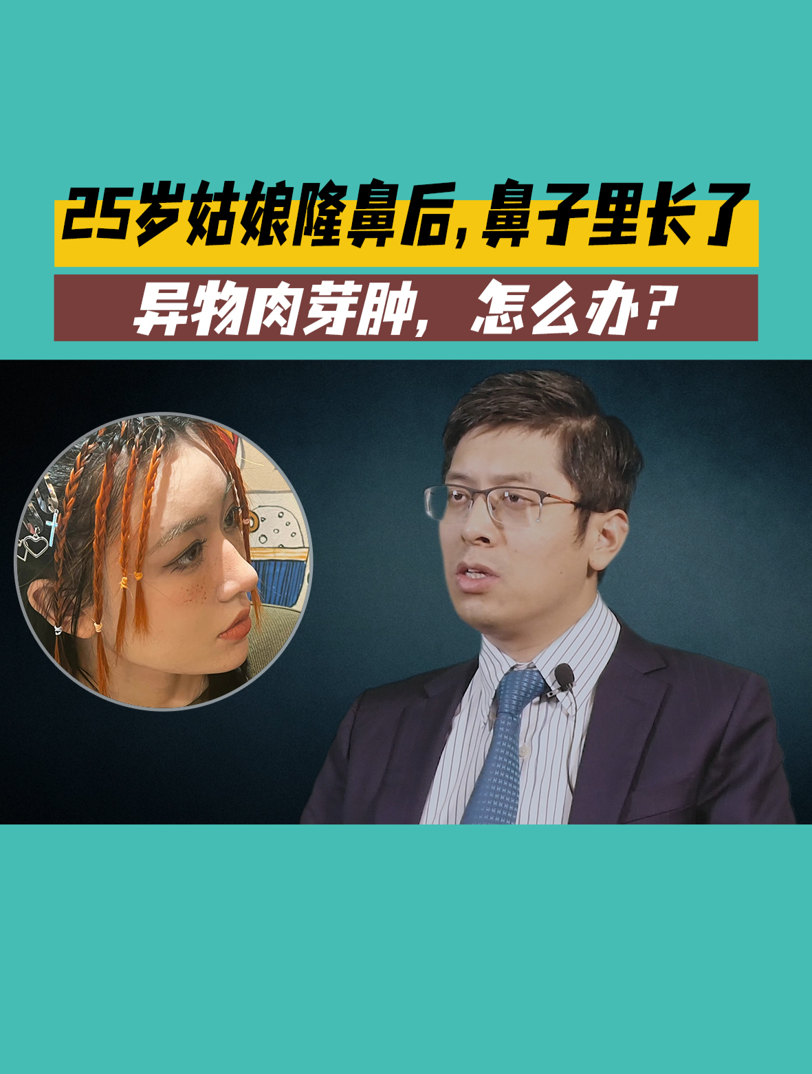 25岁姑娘隆鼻后,鼻子里长了异物肉芽肿,怎么办?