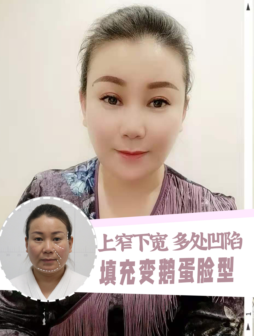 上窄下宽的脸型,填充后变鹅蛋脸