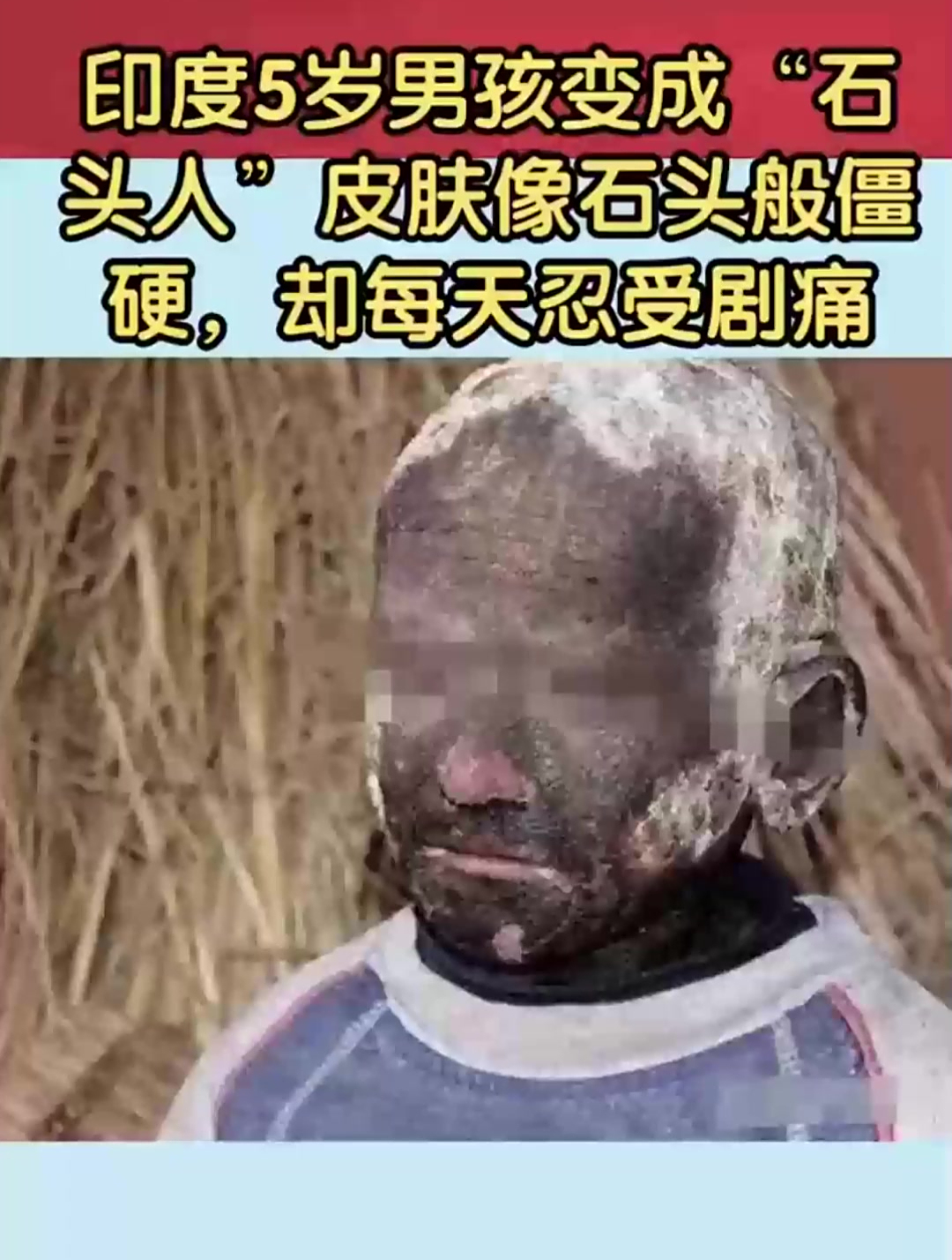 印度5岁男孩变成“石头人”皮肤像石头般僵硬,却每天忍受剧痛
