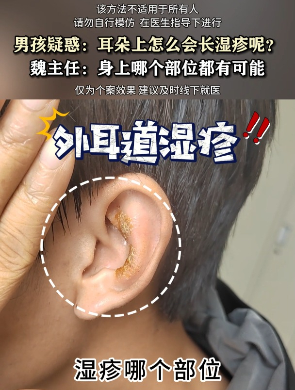 男孩疑惑:耳朵上怎么会长湿疹呢?魏主任:身上哪个部位都有可能