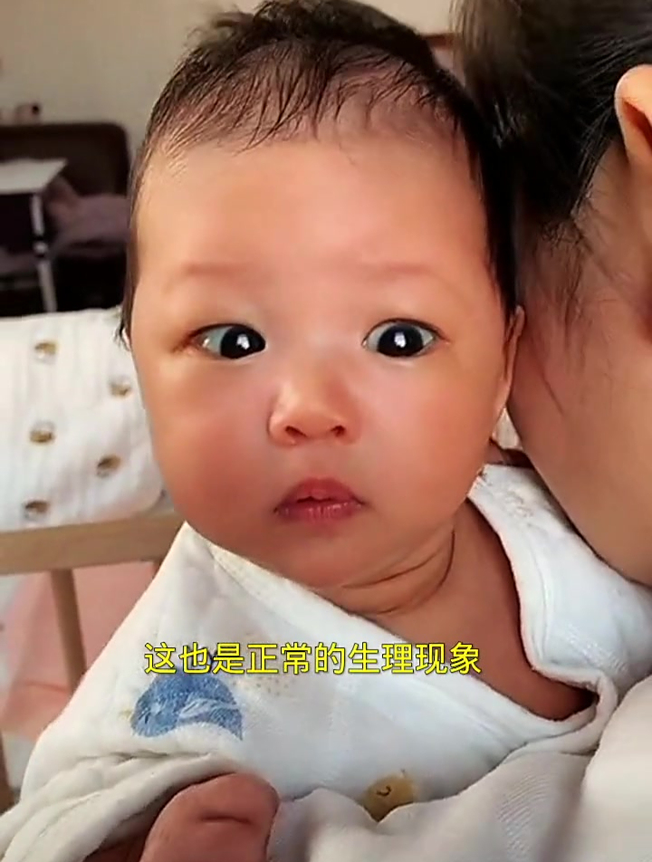 新生儿出生“斗鸡眼“咋回事“?
