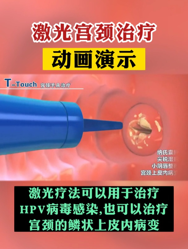 激光宫颈治疗怎么做,你知道吗?