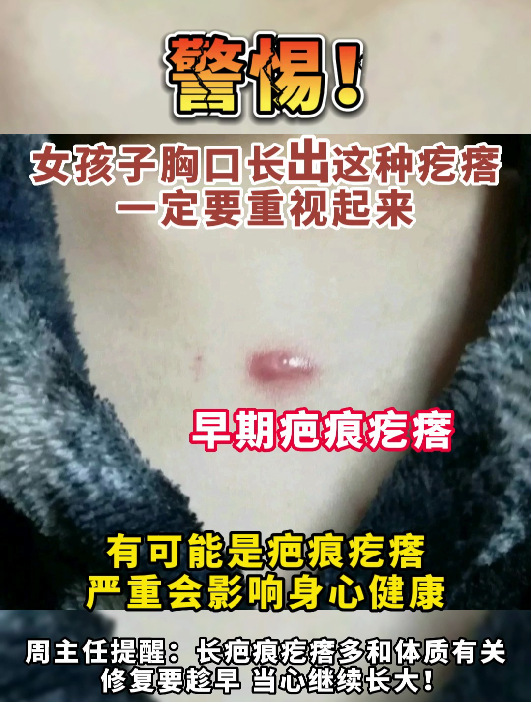 胸口长这种疙瘩,一定要注意了!