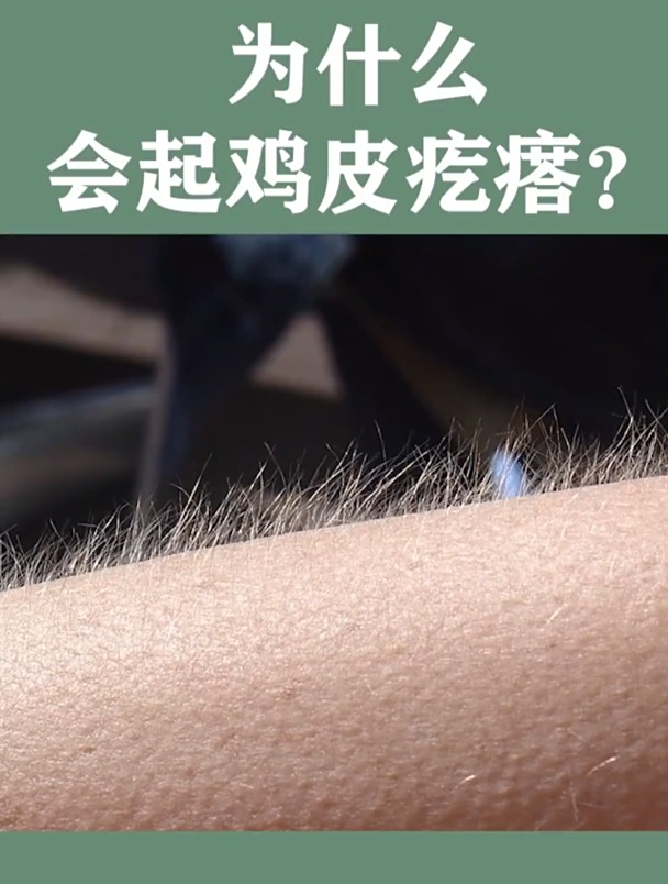 为什么会起鸡皮疙瘩?鸡皮疙瘩 科普 冷知识