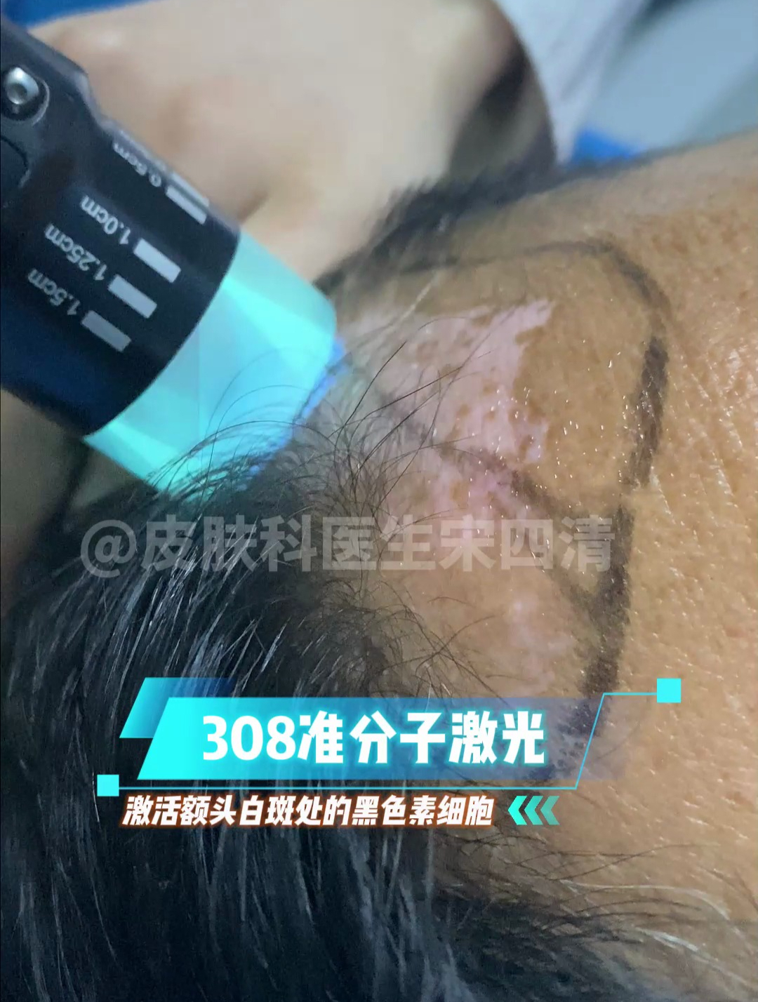 308准分子激光治疗白癜风
