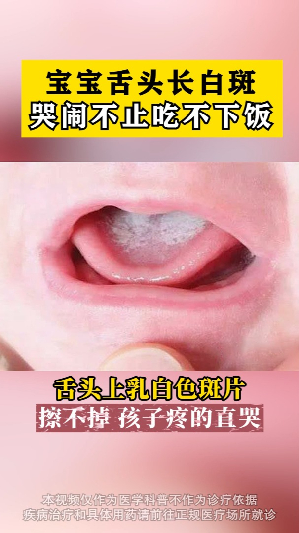 宝宝舌头长白斑,哭闹不止吃不下饭