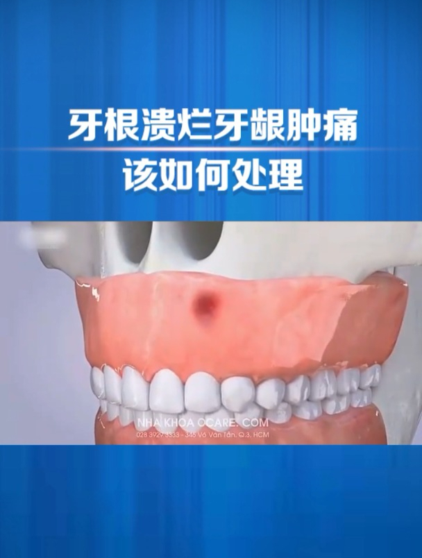 牙根溃烂、牙龈肿痛,该怎么办?