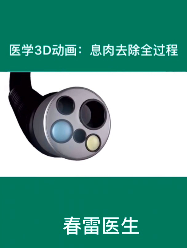 肠息肉去除的过程