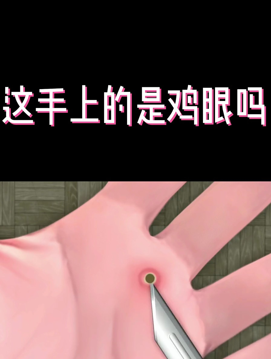 asmr沉浸式挤痘痘,这手上是长了个鸡眼吗?强迫症修手