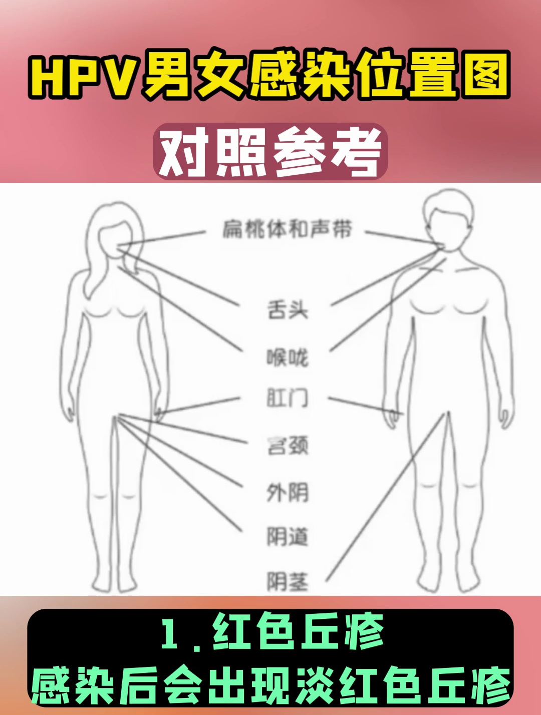 HPV男女感染位置图,快来了解一下
