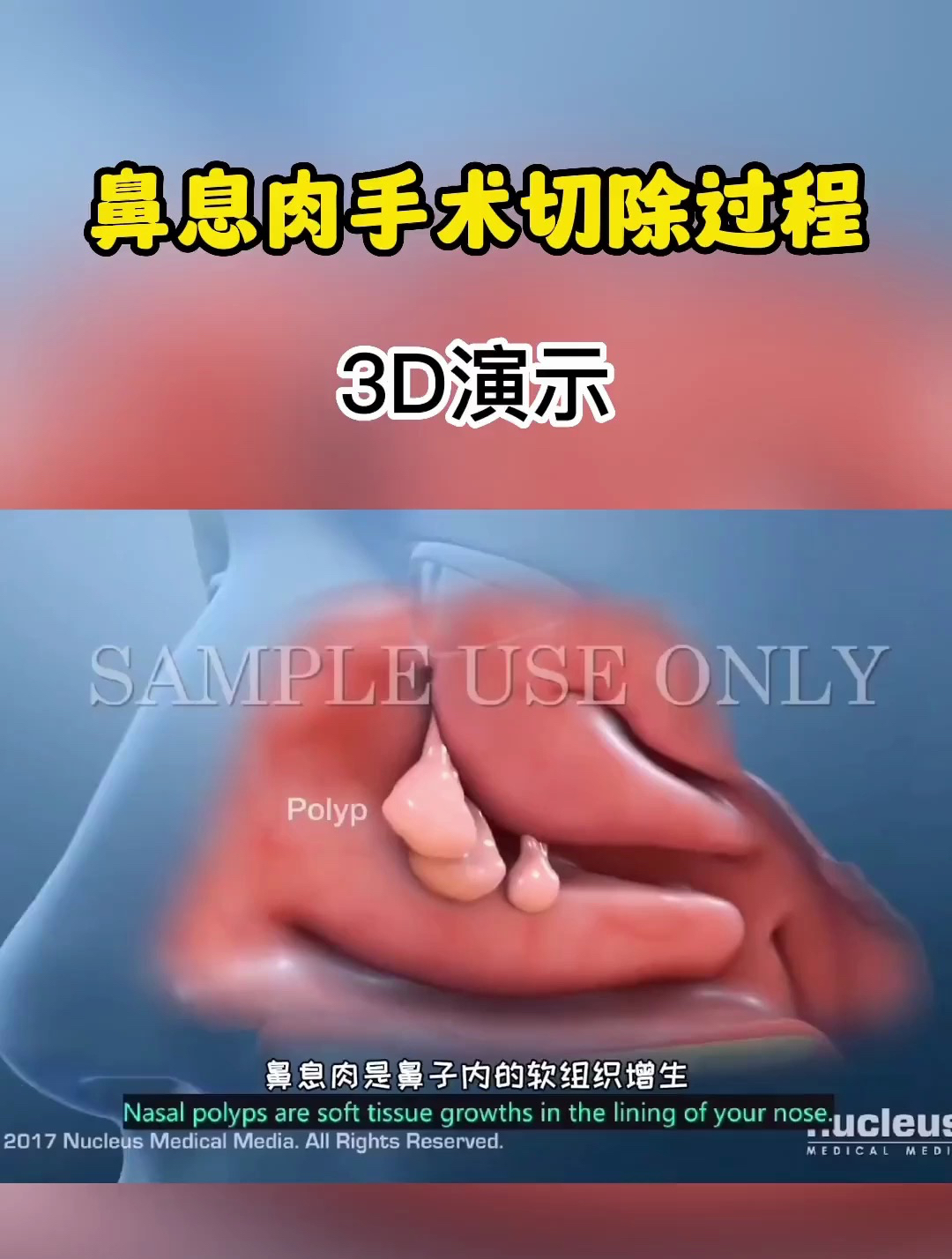 鼻息肉手术切除过程