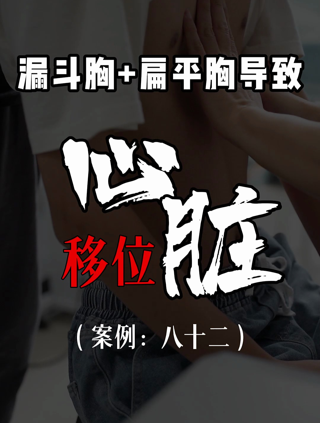 漏斗胸鸡胸医生张东升