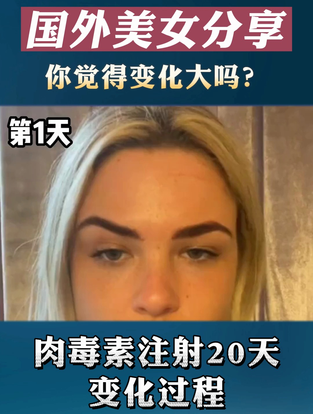 肉毒素注20天对比,你看变化大吗?